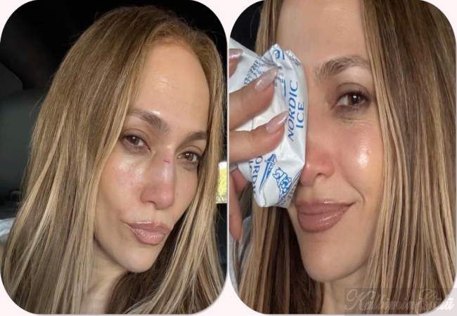 Jennifer Lopez aniden bir sakatlıkla ortaya çıktı : Son Dakika Magazin Haberleri.
